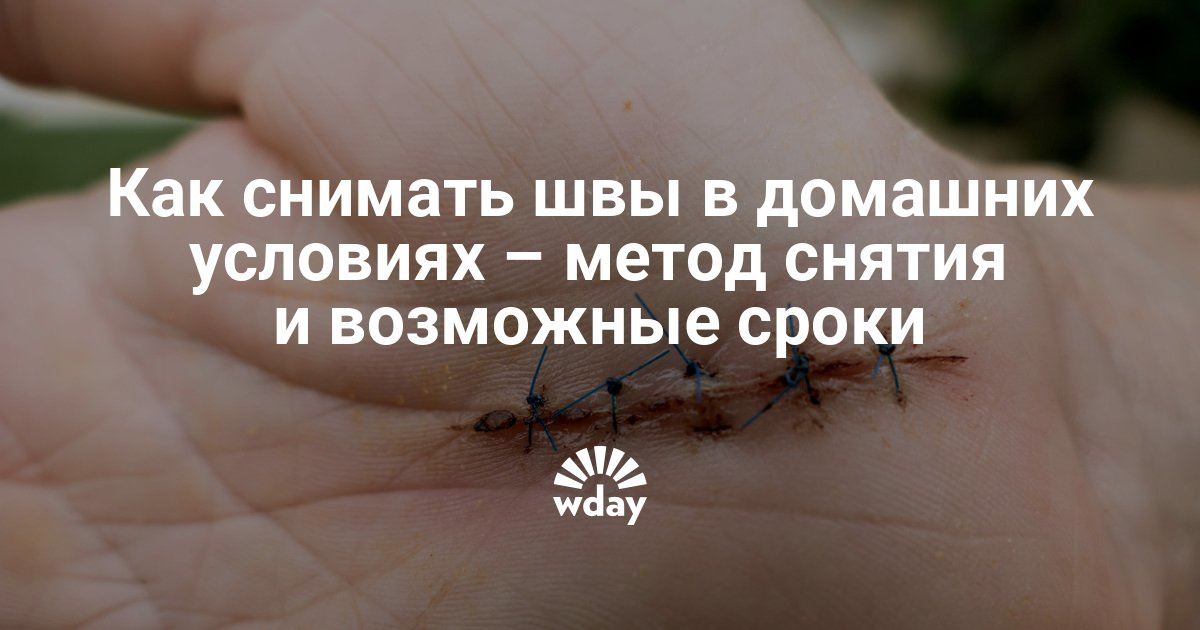 Снять швы в домашних условиях на ноге Снять швы в домашних условиях на ноге