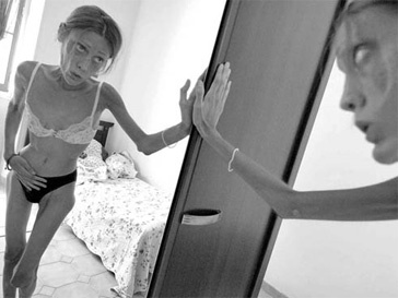 больные анорексией больные анорексией
