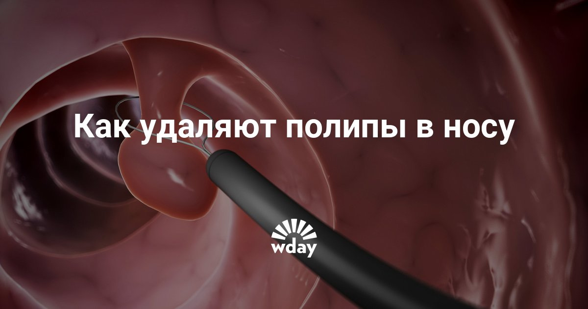 Избавляемся от полип в носу в домашних условиях Избавляемся от полип в носу в домашних условиях