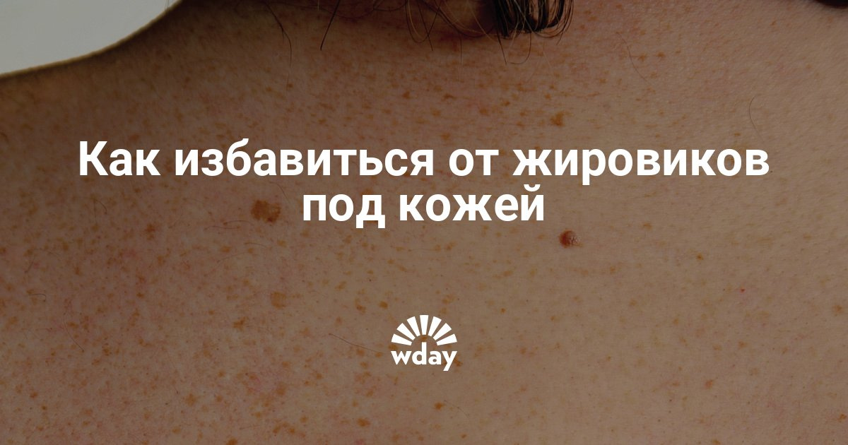 Как избавиться от жировиков на теле