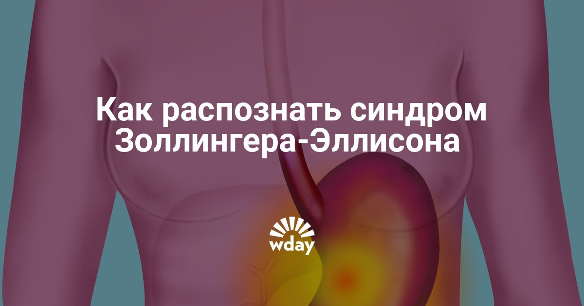 Синдром золлингера эллисона: диагностика, симптомы - Woman's Day