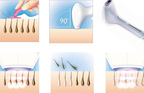 Philips Lumea помогает быстро и безболезненно избавиться от волос Philips Lumea помогает быстро и безболезненно избавиться от волос