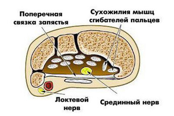 Туннельный синдром запястья Туннельный синдром запястья