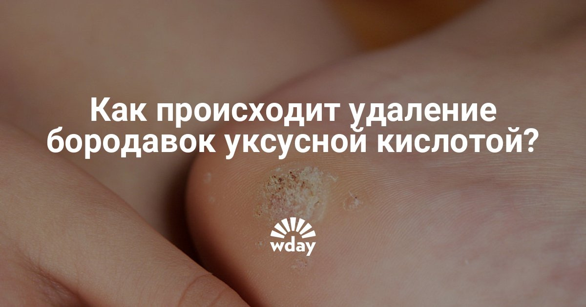 Как удалять бородавки уксусной кислотой Как удалять бородавки уксусной кислотой