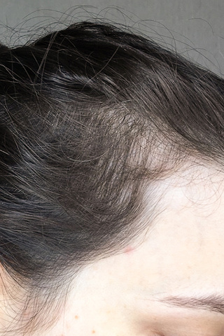 Профессиональная травма: блогер лишилась волос из-за своей же диеты