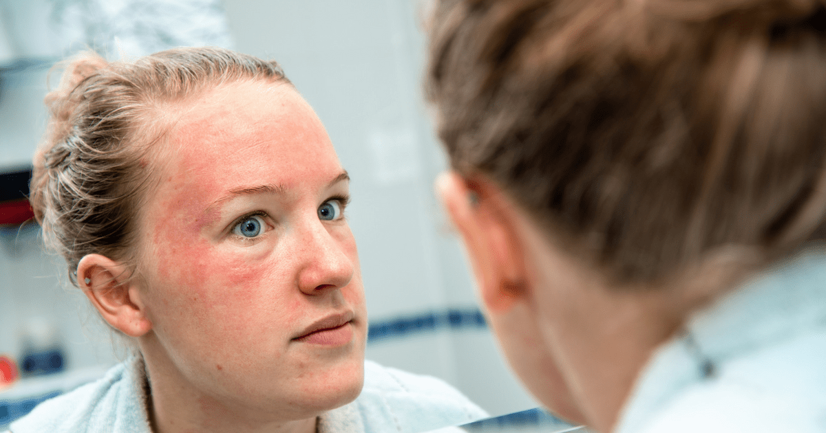 Что делать при временном покраснении кожи лица?