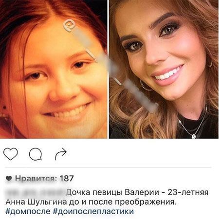 Анна Шульгина до и после