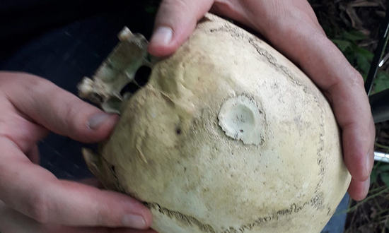 В Ингушетии археологи нашли череп со следами трепанации