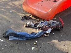 14-летнего подростка, заживо горевшего во дворе Москвы, готовят к операции по вскрытию грудной клетки