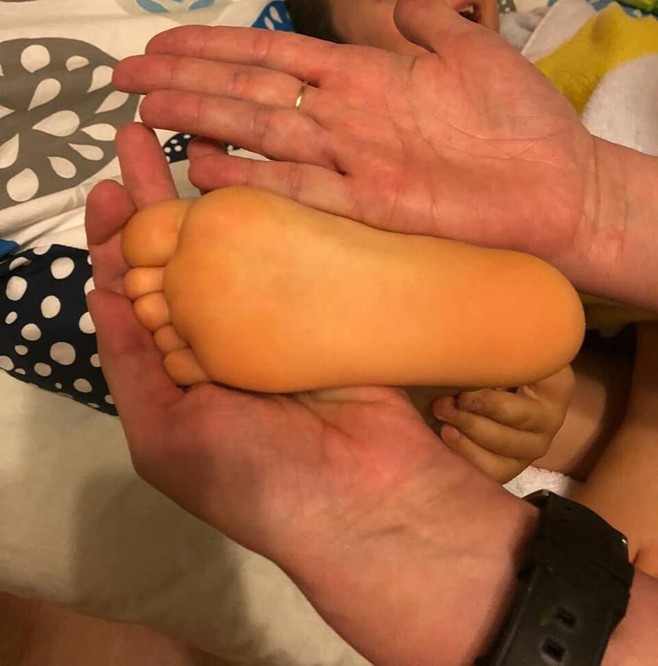 Желтая подошва ног. Каротиновая желтуха у ребенка.