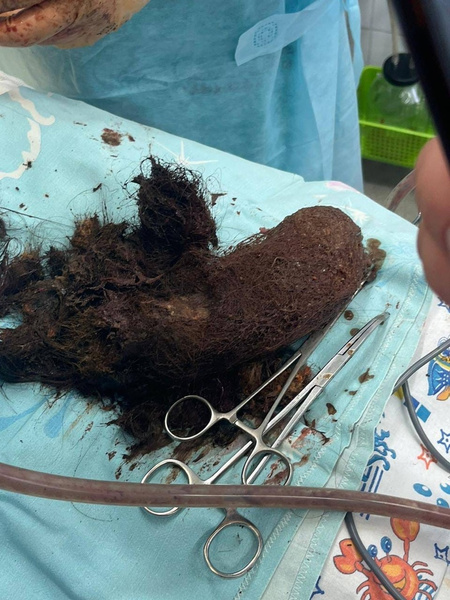 В Сургуте хирурги достали из желудка девочки ком из волос, но это не самая ужасающая находка