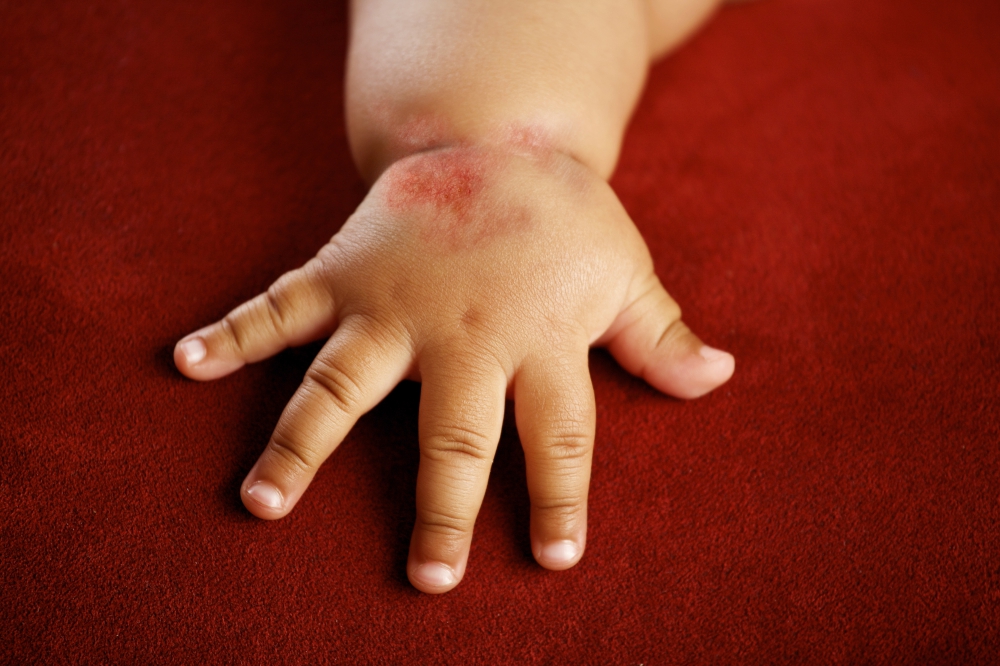 Как успокоить атопический дерматит у детей thumbnail