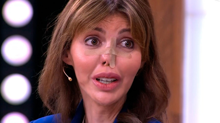 Нарастили новый нос: Алиса Аршавина впервые появилась на публике после удачной пластики лица — видео
