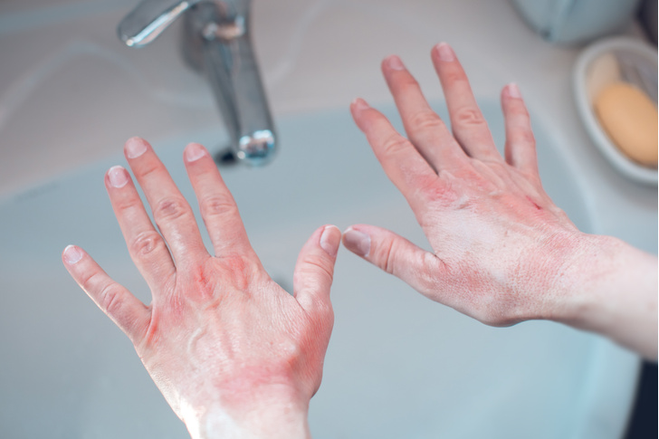 Волдыри, бугорки, воспаления: что мы знаем о «коронавирусных» пальцах?