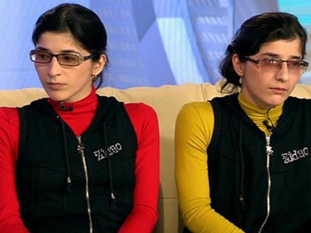 Зита и Гита: как сложилась судьба самых известных сиамских близнецов