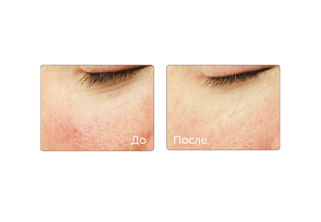 технология HydraFacial фото до и после