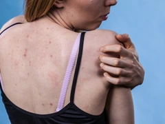 Как избавиться от прыщей на спине: рассказывают пользовательницы Woman.ru