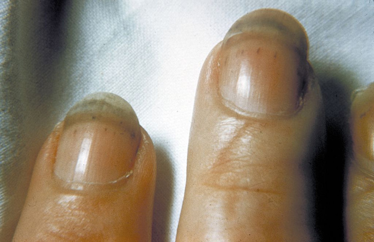 Полоски на ногтях причины фото