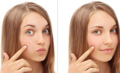Как избавиться от подкожного клеща на лице: отвечают пользовательницы Woman.ru