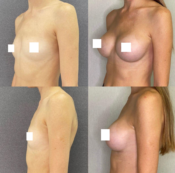 6 фото, которые вы должны увидеть, прежде чем решитесь на пластику груди