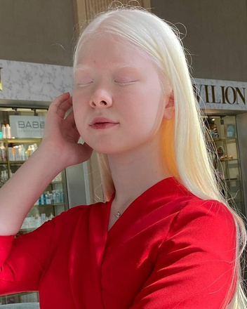 Дети-альбиносы: как выглядят, в чем их особенность