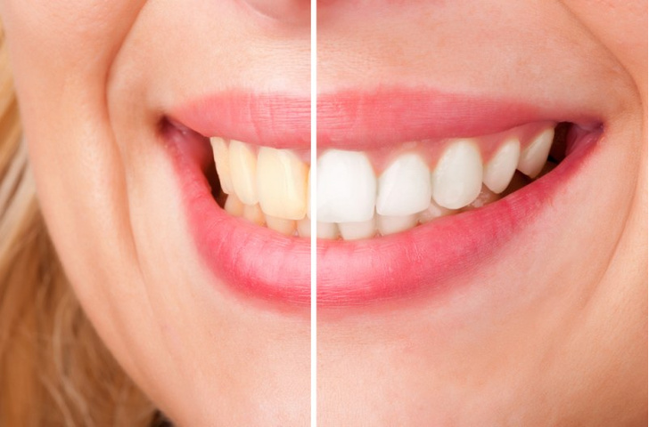 Способы отбеливания зубов активированным углем