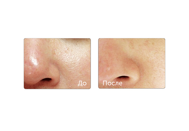 технология HydraFacial фото до и после