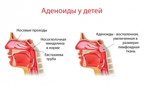 Аденоиды у детей