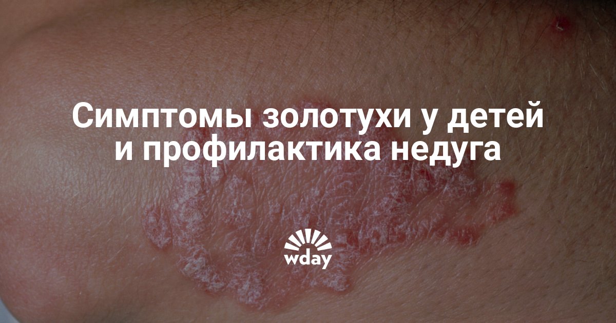 Симптомы золотухи у детей | theDay