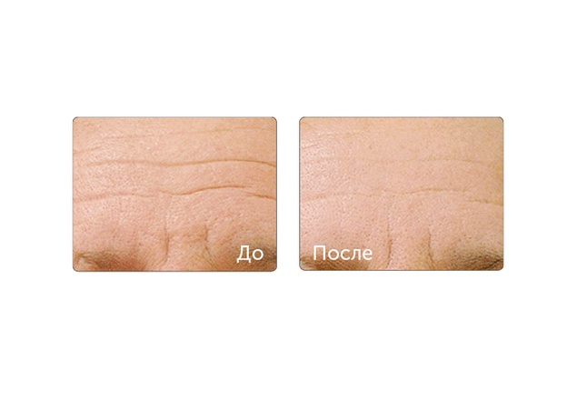 технология HydraFacial фото до и после