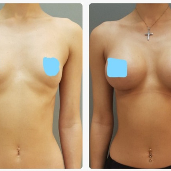 ᐉ Когда нужна мастопексия: как распознать обвисшую грудь | Статьи | optnp.ru