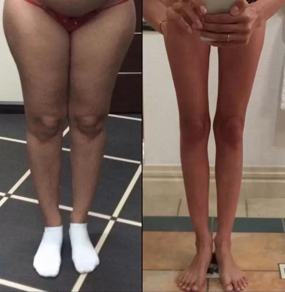 Алана Мамаева показала, как реально выглядели ее ноги, когда она весила 90 кг