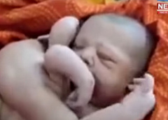 В Индии родился ребенок с четырьмя руками и ногами