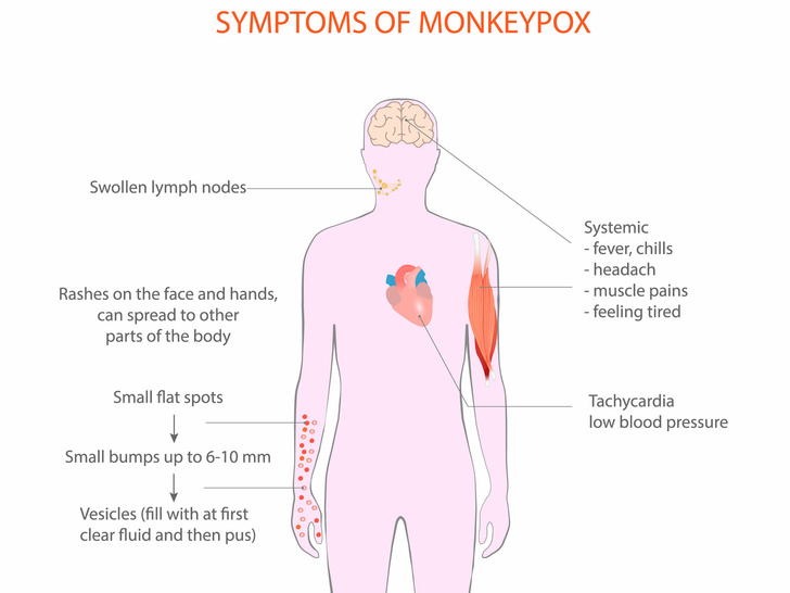 Симптомы обезьяньей оспы: 8 признаков того, что у вас может быть новый вирус