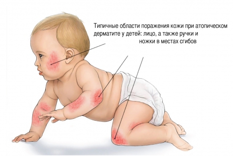 Атопический дерматит у детей симптомы