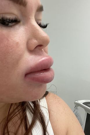 «Две сосиски»: блогерша показала результат увеличения губ — после этих фото вы не захотите ставить филлеры