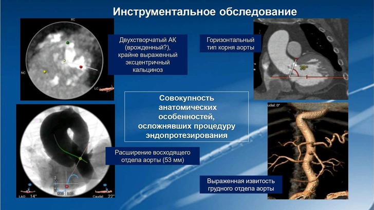 Любая операция — верная смерть: врачи спасли мужчину с раком кишечника и заболеваниями сердца