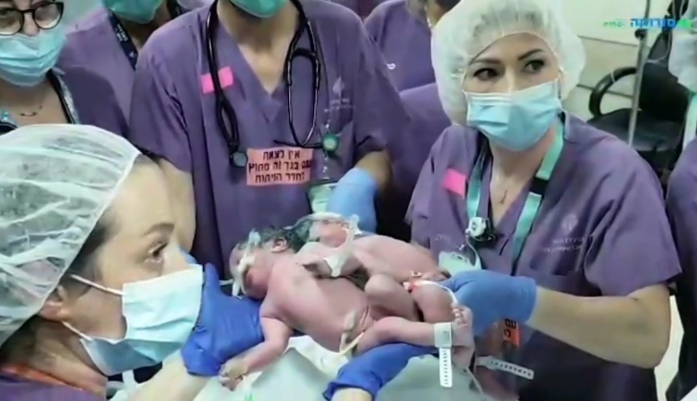 врачи разделили годовалых близнецов, сросшихся затылками