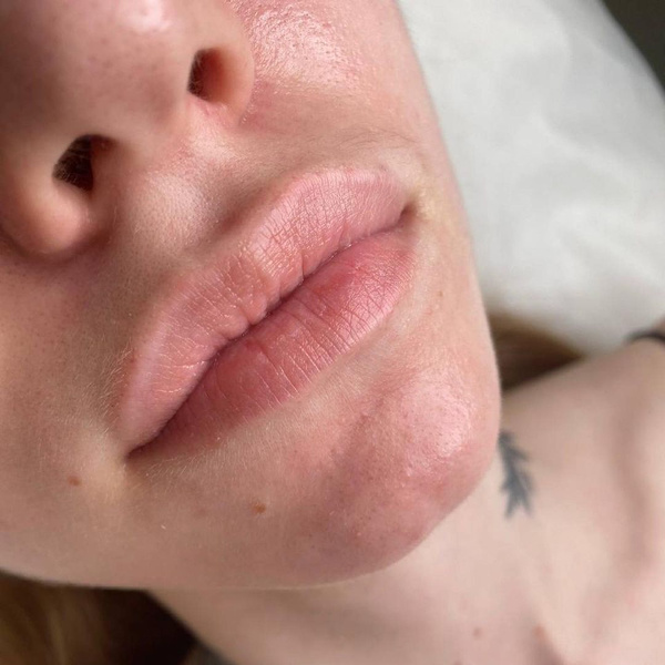 Увеличение губ усы гиалуроновые. Усы от гиалуроновой кислоты.