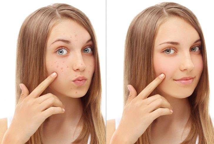 Как избавиться от подкожного клеща на лице: отвечают пользовательницы Woman.ru