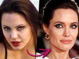 Делала ли Анджелина Джоли ринопластику? Мнение хирургов