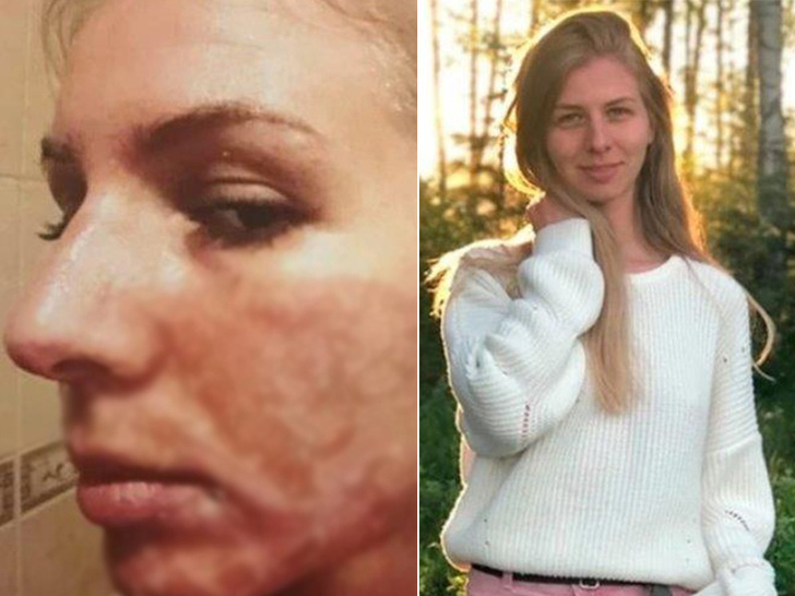 «Казалось, что рот может лопнуть»: петербурженка чуть не сгорела в солярии