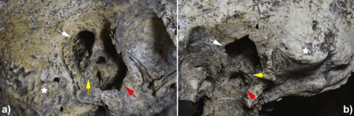 Боль была невыносимой: найден череп человека со следами самой древней операции