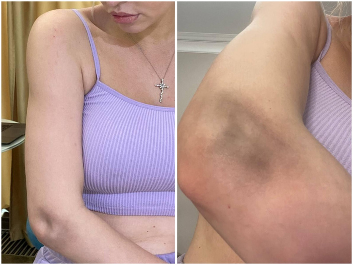 Милана Тюльпанова получила многочисленные травмы после падения с электросамоката – фото