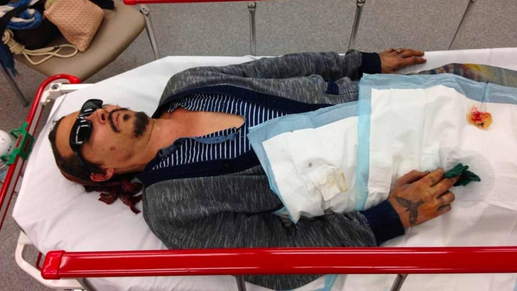 В СМИ появилось фото Джонни Деппа, пострадавшего в драке с Эмбер Херд