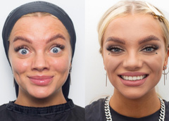 Как ботокс меняет внешность: 35 фото до и после