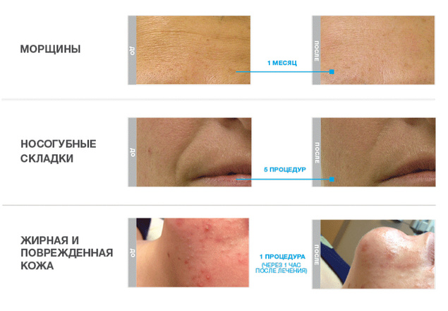 технология HydraFacial фото до и после