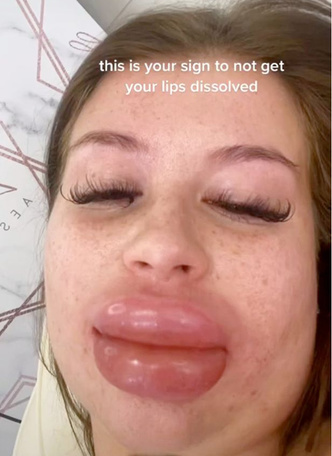 Женщина увеличила губы, но они стали в 10 раз больше — фото результата