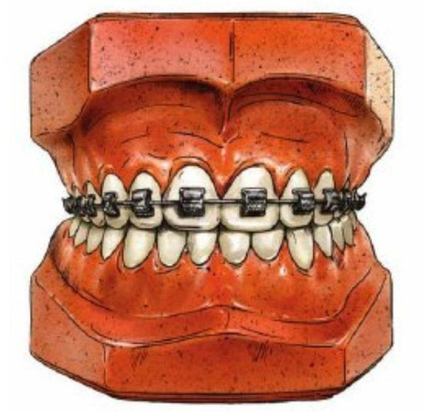 На страже прикуса: как военные и космические технологии помогли создать брекеты