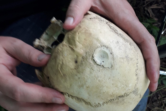 В Ингушетии археологи нашли череп со следами трепанации